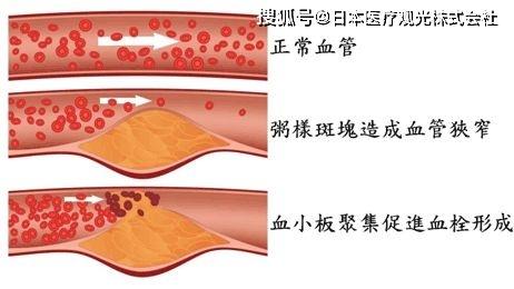 隔空测“心”更持久、更靠谱——我科学家实现非接触心脏活动监测技术突破