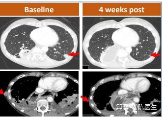 以色列研究人员利用纳米技术提升CAR-T疗法抗癌疗效