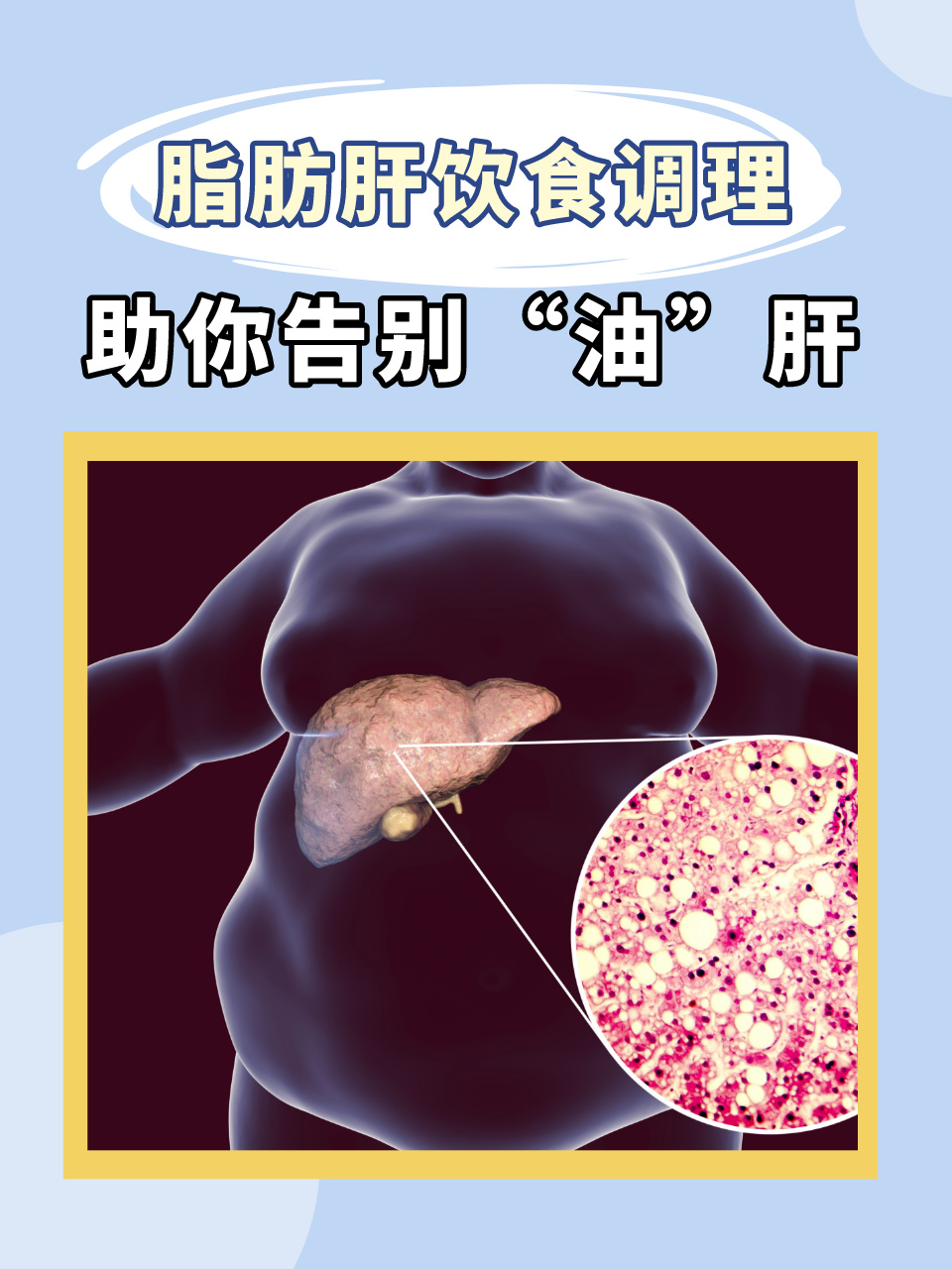 加速代谢相关脂肪肝患者肝纤维化的“隐形杀手”被发现